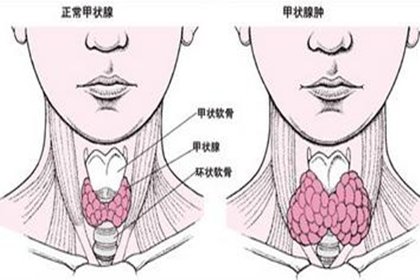 甲狀腺結(jié)節(jié)會(huì)導(dǎo)致脖子疼嗎 甲狀腺結(jié)節(jié)有什么癥狀