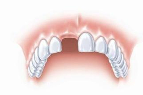 什么情況下適合種植牙齒 種植牙齒分為幾個(gè)階段