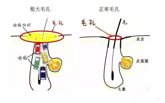 臉上毛孔粗大像雞皮一樣怎么辦