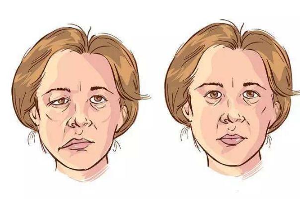 面癱一般多久恢復正常 半邊臉面癱一般多久恢復正常