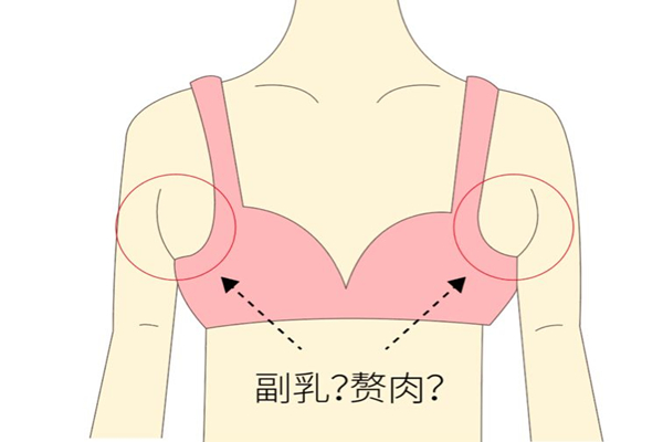 副乳切除好還是不切 副乳切除會留疤嗎