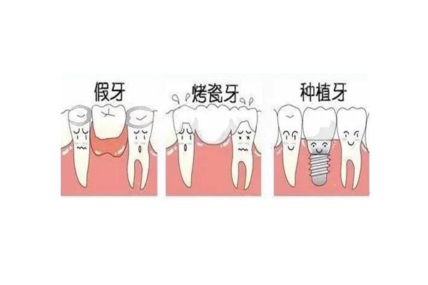 烤瓷牙是不是越貴越好 烤瓷牙是永久的嗎