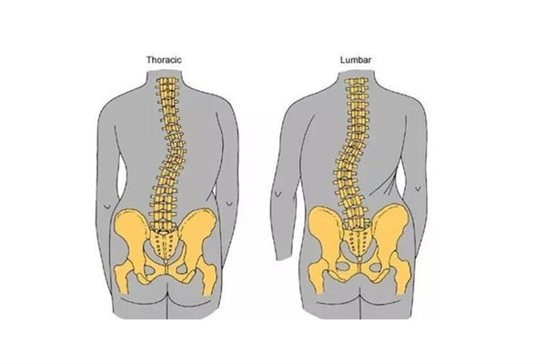 骨盆前傾可以通過正骨恢復(fù)嗎 骨盆前傾去哪里矯正