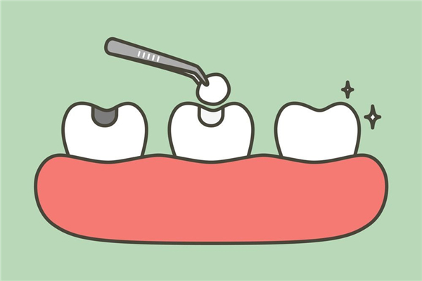 補牙多少錢一顆 補牙要注意什么