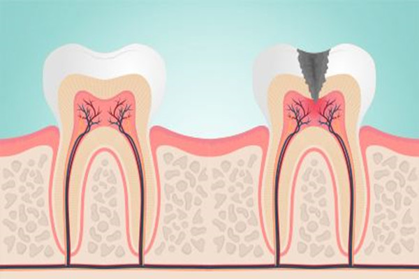 牙齒敏感會(huì)導(dǎo)致牙髓炎嗎 牙齒敏感的危害
