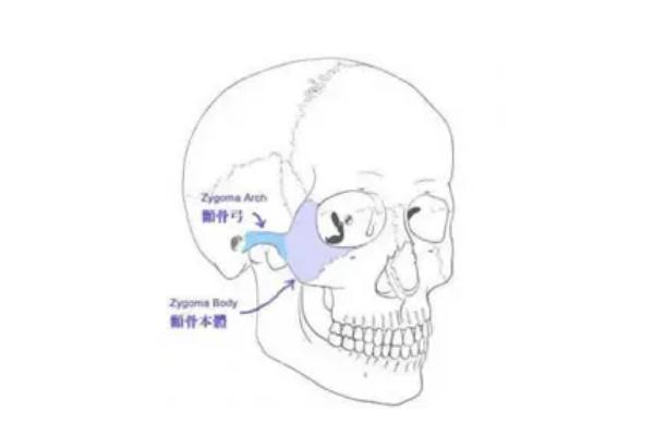 顴骨內推手術多少錢啊 顴骨內推后遺癥