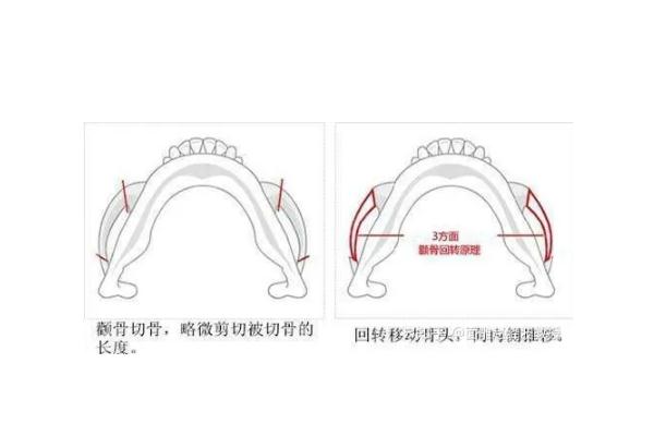 顴骨內推的釘子需要取出嗎 顴骨內推是幾級手術