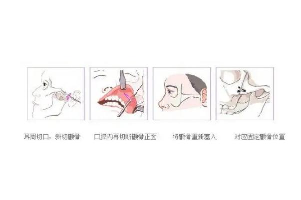 顴骨內(nèi)推的釘子需要取出嗎 顴骨內(nèi)推是幾級(jí)手術(shù)