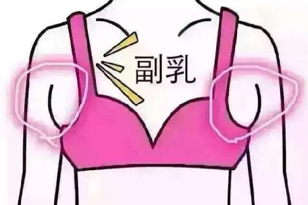 副乳切除手術(shù)會(huì)有疤痕嗎 副乳切除手術(shù)怎么才能看不到疤痕